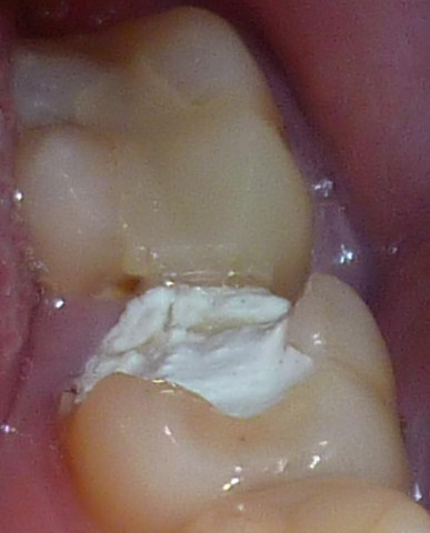 Was tun rausgefallen zahnfüllung Provisorium (Zahn)