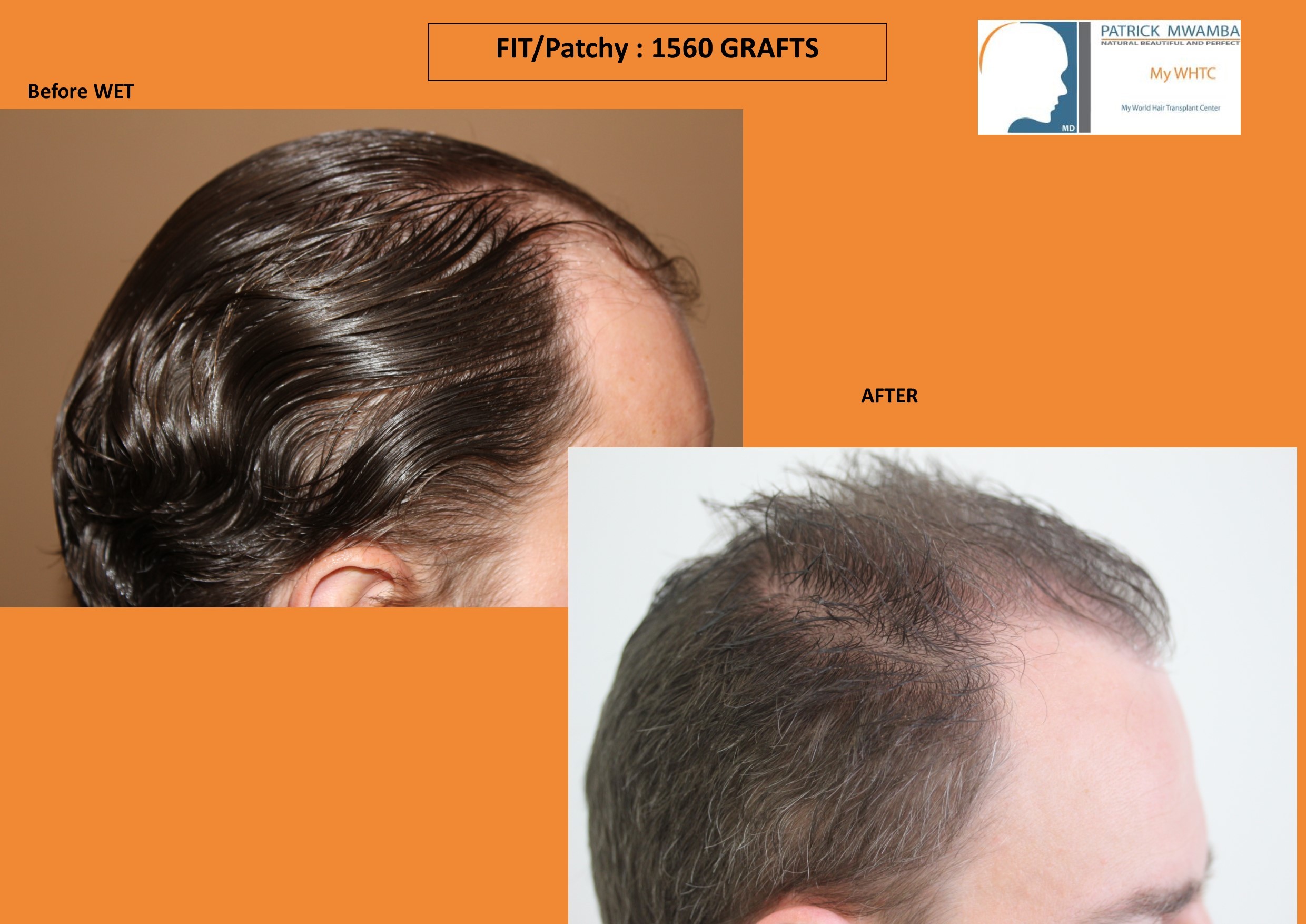 Hair Loss Forum - My WHTC+ Dr Patrick Mwamba -1560 grafts FUE by FIT patchy  shaven