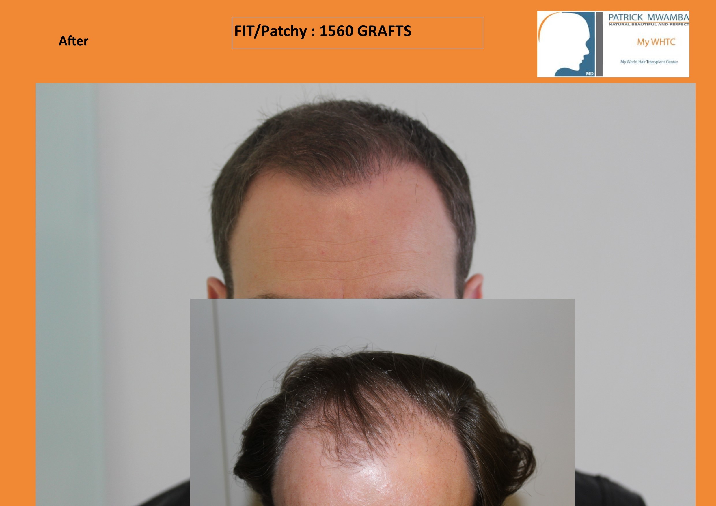 My WHTC + Dr Patrick Mwamba -1560 grafts FUE by FIT patchy shaven | Hair  loss Forum - Hair Transplant forums